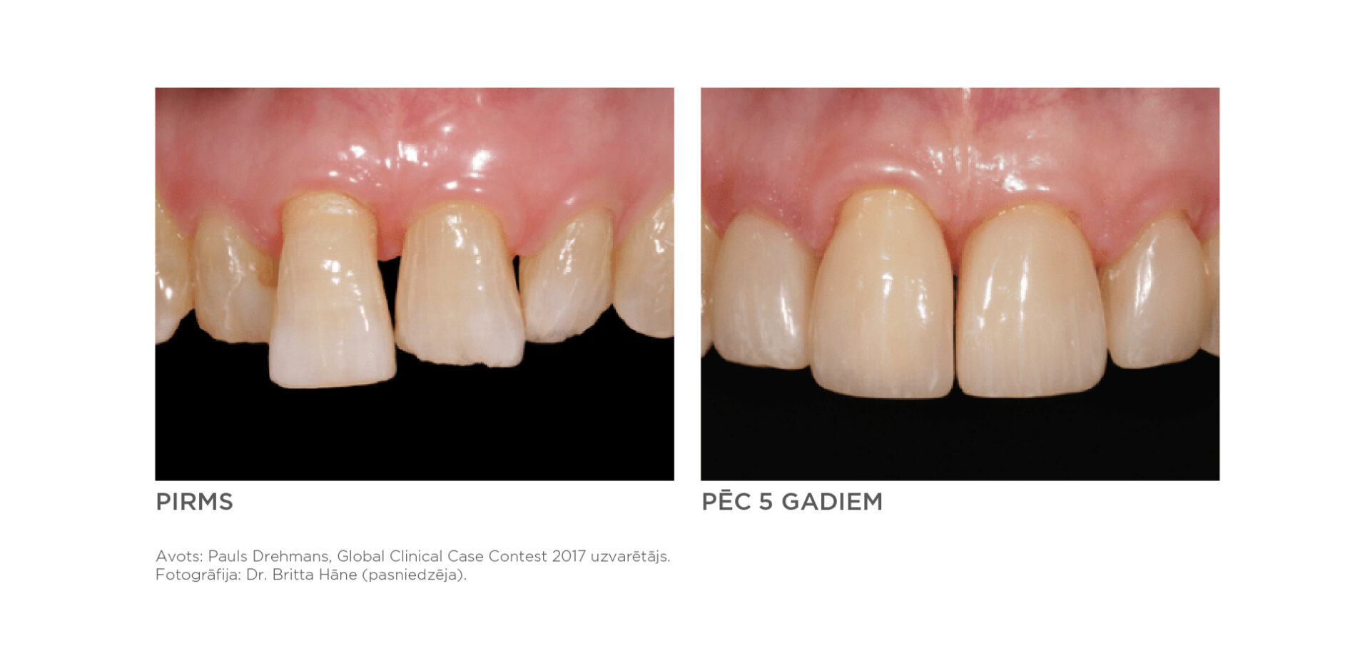 2025 10 DentsplySirona CeramXSpectraST 4