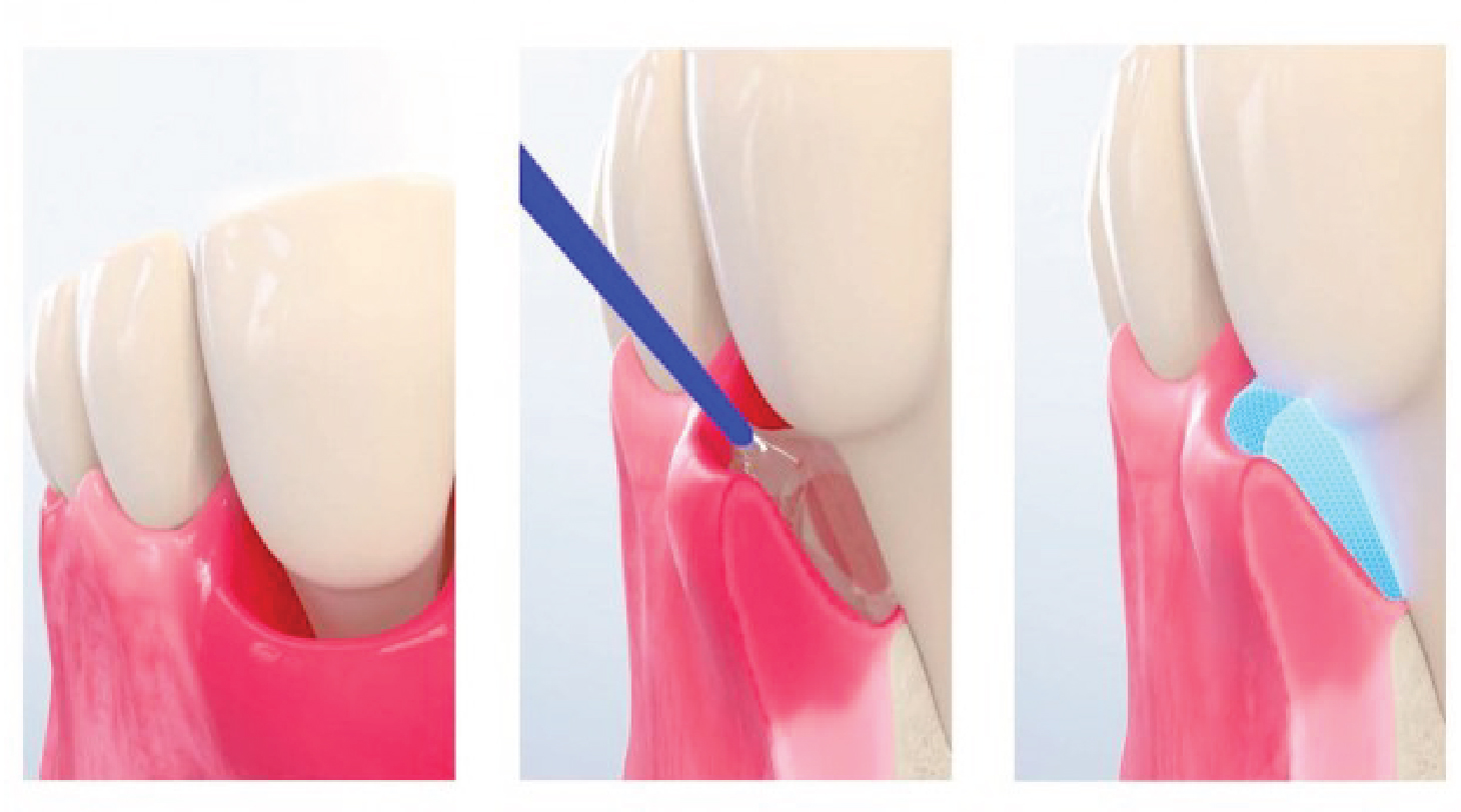 2025 10 Geistlich Pocket X 2