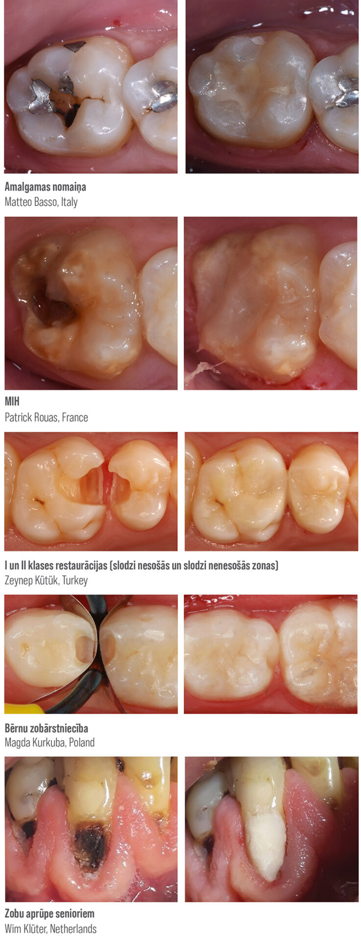 EQUIA Forte HT - unikālā hibrīdstikla tehnoloģija 2 2026 01 GC EquiaForte kliniskie piemeri 01